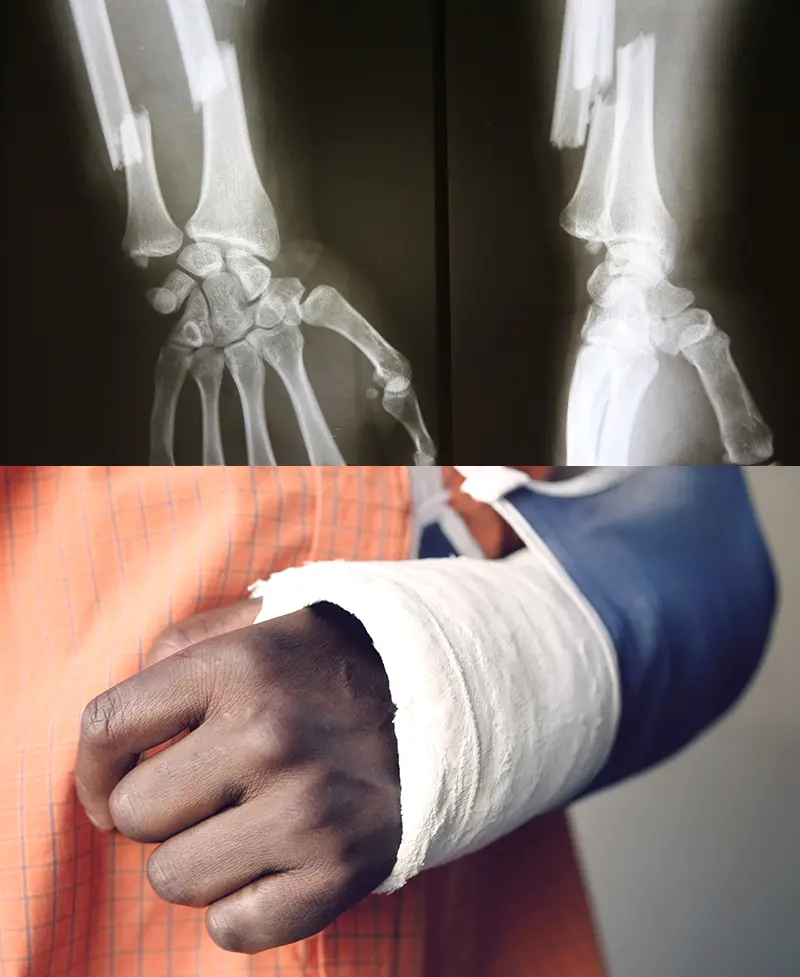 broken bones after personal injury accident