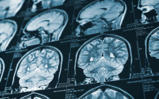 How Much Compensation Can You Get for a Brain Injury in Arkansas?