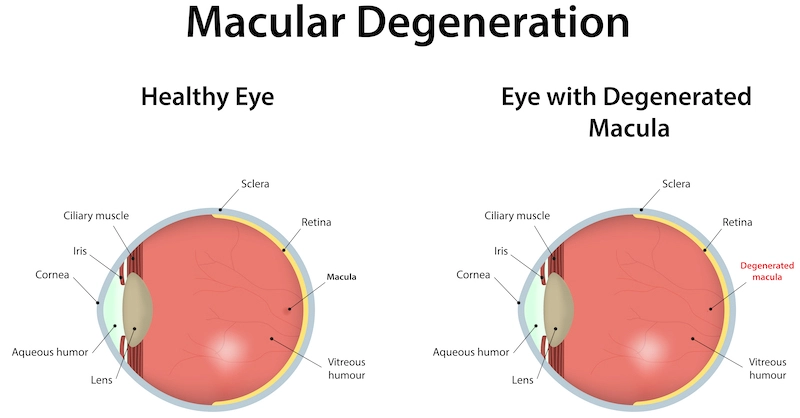 Degneneration